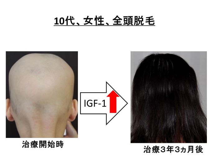 円形脱毛症　病院